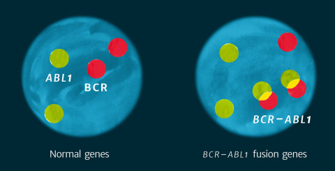 Bcr-Abl1 FISH 